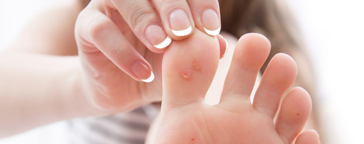 WARTS TREATMENT IN HOMEOPATHY