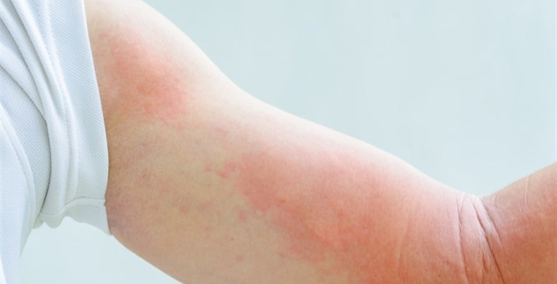 ECZEMA - EFFECTIVE TREATMENT IN HOMEOPATHY