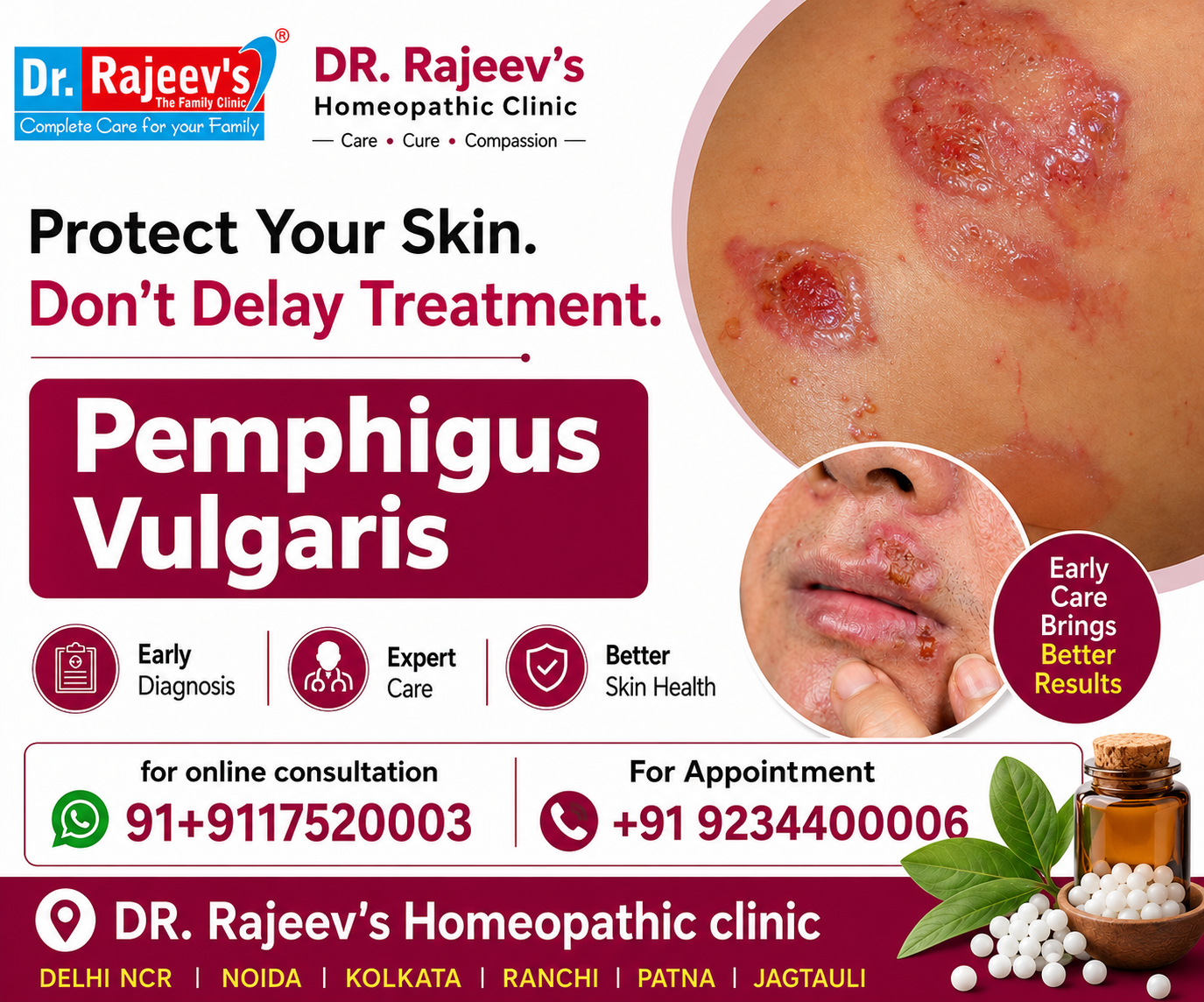 Pemphigus Vulgaris: Symptoms, Causes and  Best Homeopathic Treatment for Healthy Skin