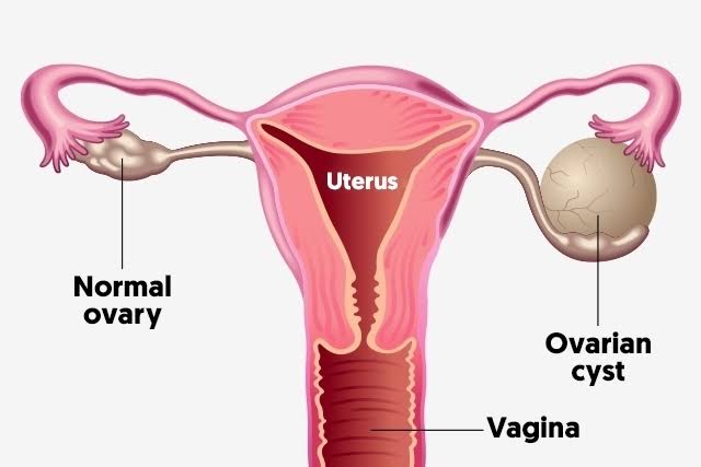 डिम्बग्रंथि पुटी के लिए होम्योपैथी उपचार। Ovarian Cyst