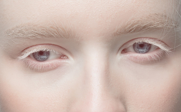 ALBINISM TREATMENT