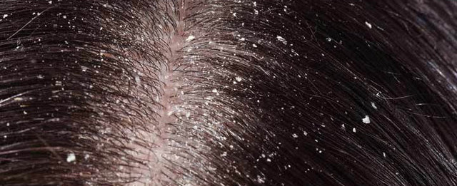 GET RID OF DANDRUFF WITH HOMOEOPATHY