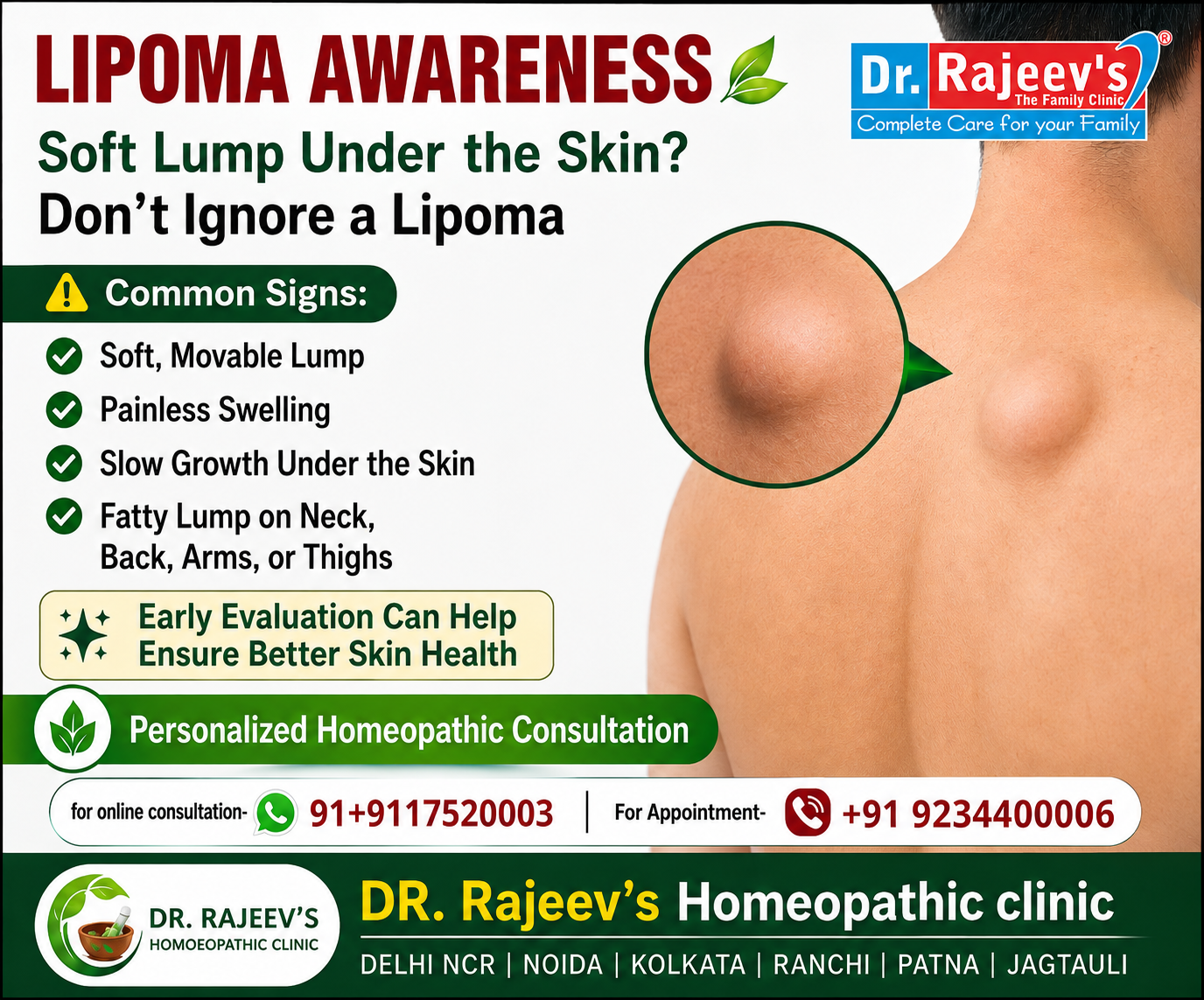 Lipoma Symptoms, Causes and Homeopathic Treatment for Healthy Skin