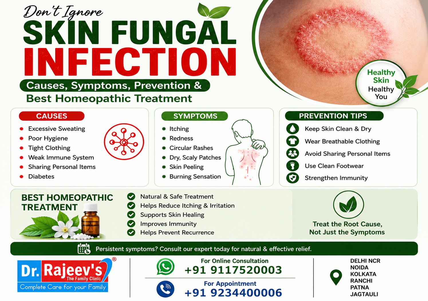 Skin Fungal Infection: Causes, Symptoms, Prevention & Best Homeopathic Treatment