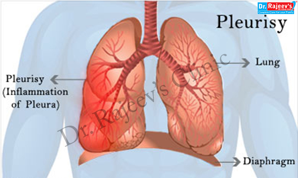 final days of peritoneal cancer