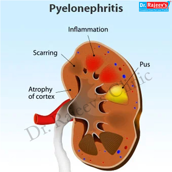 Pyelonephritis Images