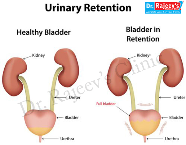 homeopathic treatment for Retention of Urine in homeopathy