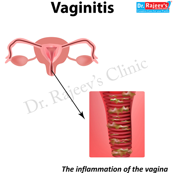 Homeopathic Treatment For Vaginitis Treatment Of Vaginitis