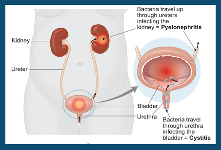 homeopathic treatment for Pyelonephritis in pregnancy in