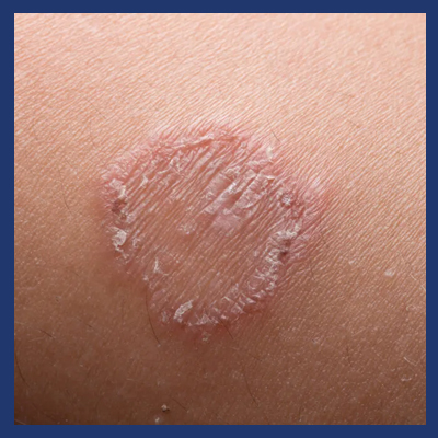 Psoriasis vs. Fungal Infections: Photos and Differences in Symptoms |  MyPsoriasisTeam