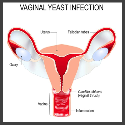 vaginal opening yeast infection