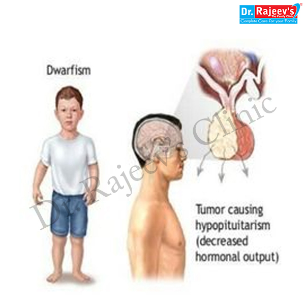 Best Homoeopathic Treatment For Dwarfism