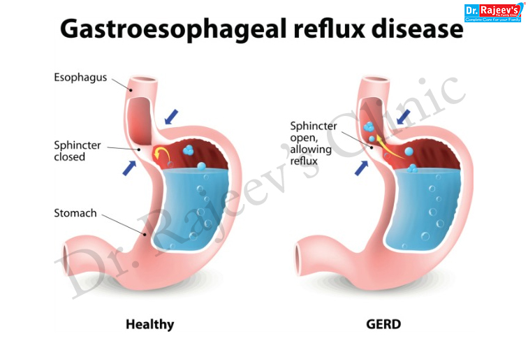 Homeopathic Treatment for Gerd, Treatment of Gerd(Gastro-esophageal)