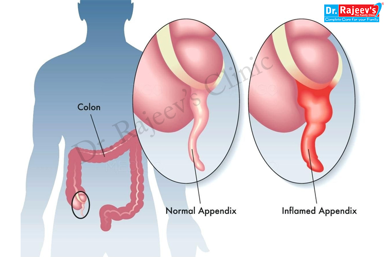 burst appendix symptoms