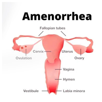 amenorrhea