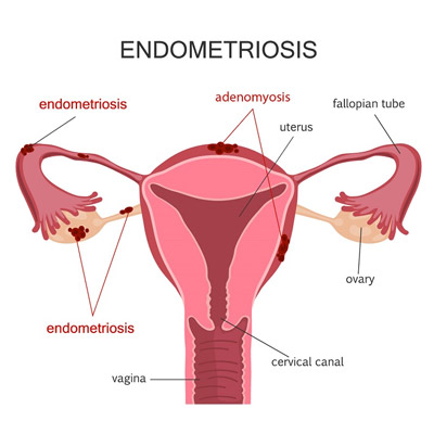 Endometriosis and Women's Tendency Towards Blood Clotting