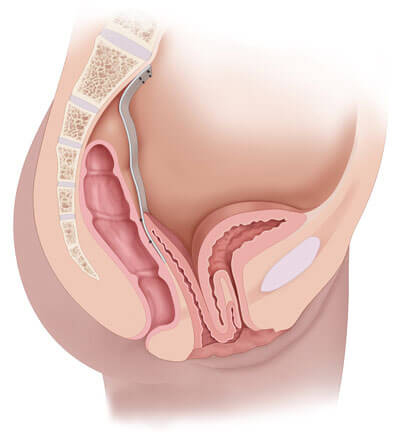 Bladder Prolapse And Homeopathy