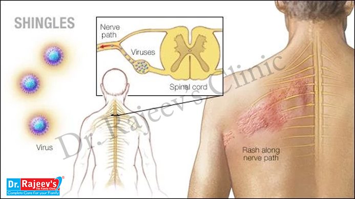 Patient Suffers from Post-herpetic Neuralgia, Pain Following Shingles, for  25 Years After Missing the Optimal Period for Treatment - FV Hospital