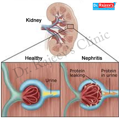 nephritis acute homeopathy treatment causes