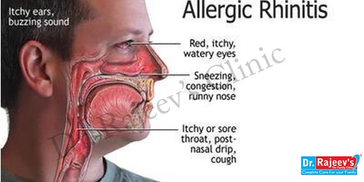 Best Allergic Rhinitis Treatment in Ranchi, Delhi