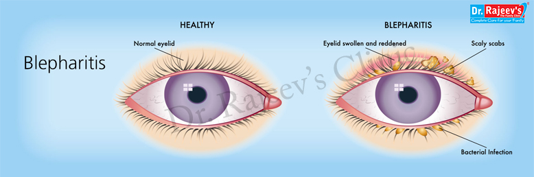 Blepharitis Information Symptoms Treatment Options 9922