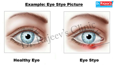 homeopathic treatment for Stye in homeopathy, Stye Treatment in Patna