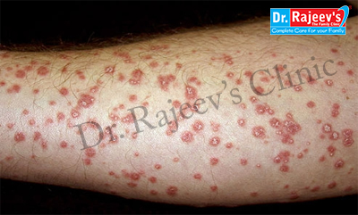 Homeopathic Treatment for Psoriasis, Treatment of Psoriasis