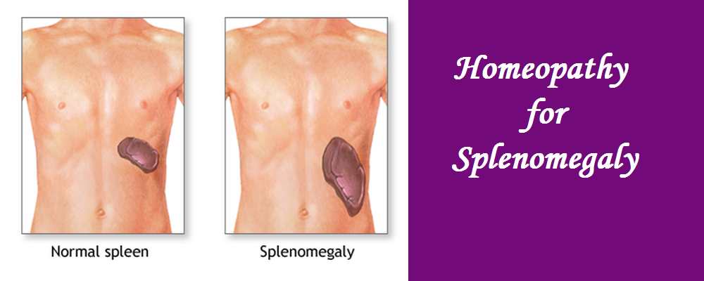 splenomegaly-homeopathic