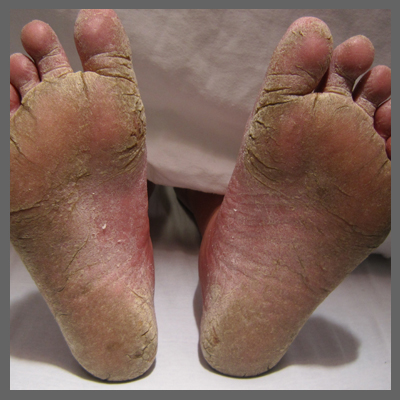 Athlete's Foot or Tinea Pedis - Best Diabetes Hospital in Kerala