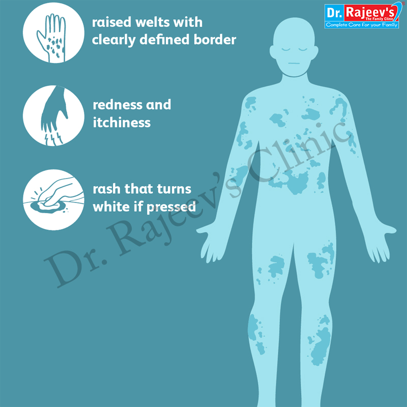 Homeopathic Treatment for Urticaria, Treatment of Urticaria