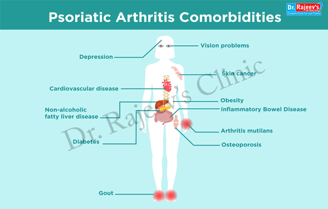 Psoriatic Arthritis