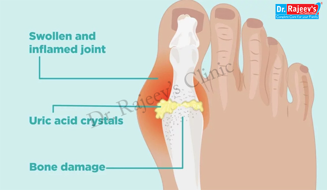 Homeopathic Treatment for Gout, Uric Acid Treatment