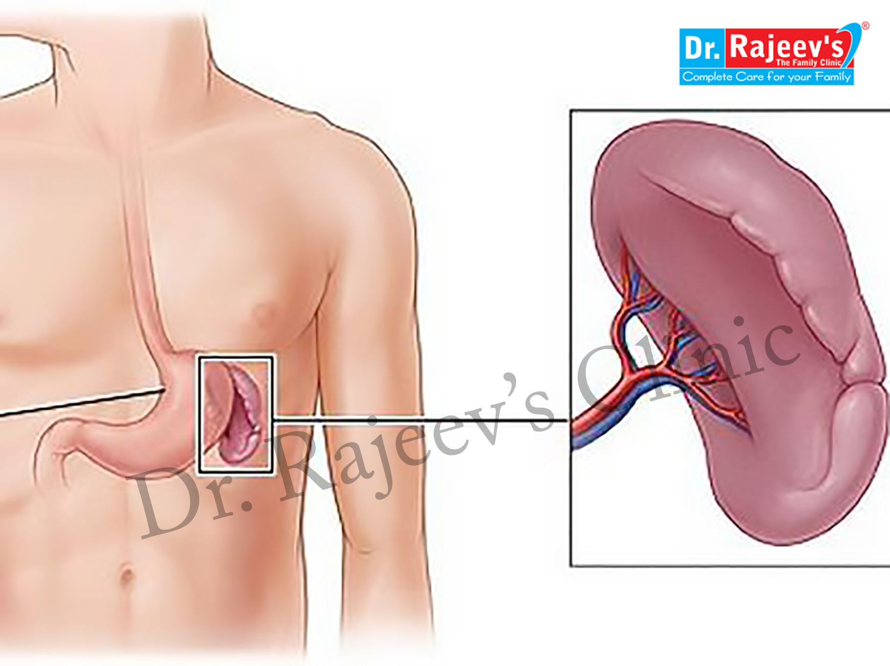 homeopathy-treatment-for-splenomegaly-treatment-of-splenomegaly