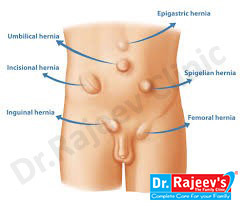 Femoral Hernias