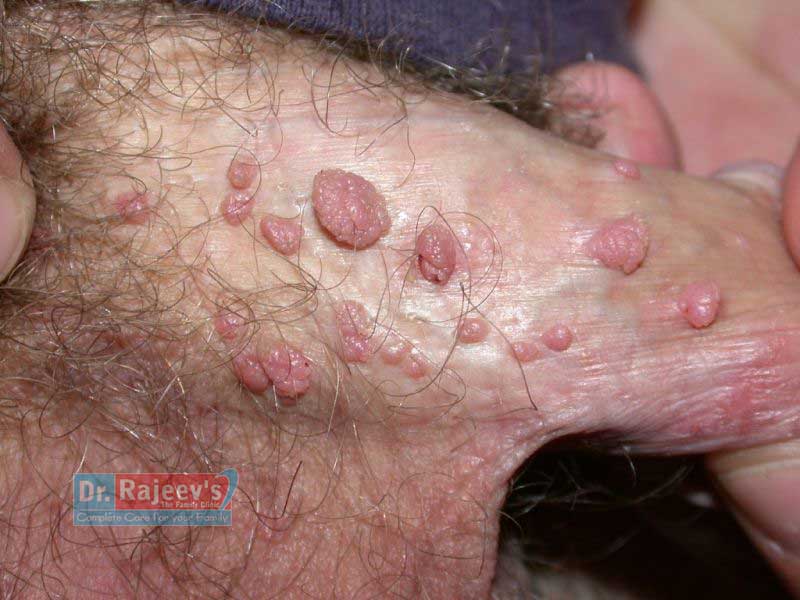 detoxifiere de colon lichid neck papilloma treatment