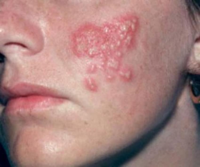 Jock Itch (Tinea Cruris) - Causes, Symptoms, Diagnosis