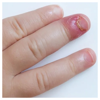 What you need to know about pseudomonas nail infections aka 