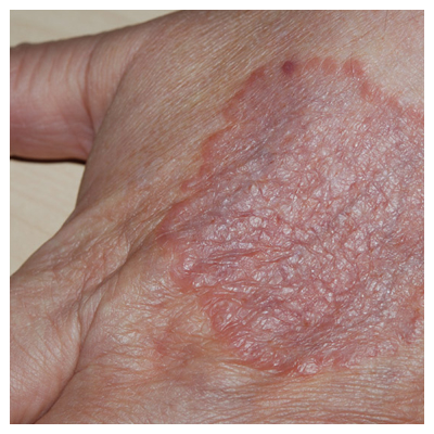 Ringworm vs. Eczema: Symptoms, Causes, Treatment, & More - GoodRx