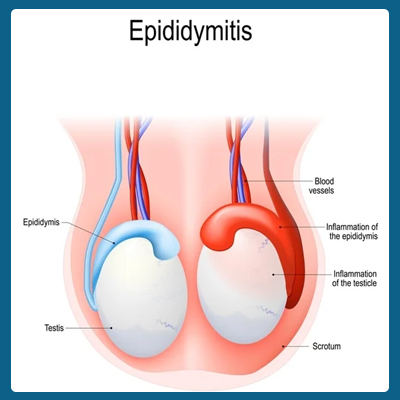 epididymis swollen