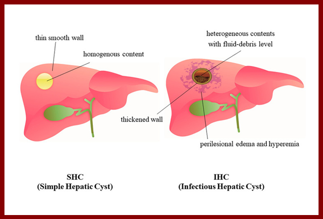 Liver Cyst - its symptoms, prevention and treatment - MyHealth