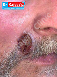 BEST Homeopathy Treatment for BASAL CELL CARCINOMA