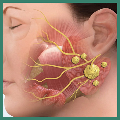 submandibular gland swelling home remedies