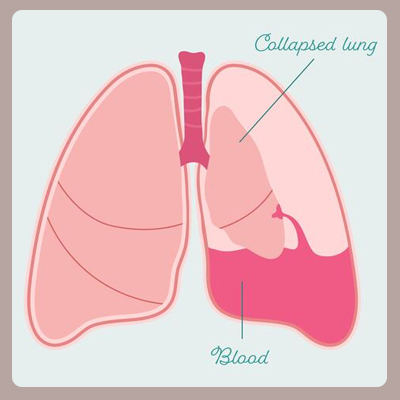 homeopathic treatment for hemothorax in homeopathy, treatment of ...