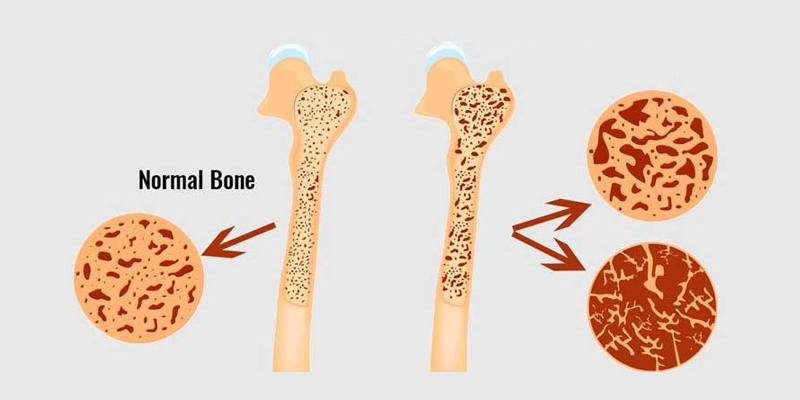 homeopathic-treatment-for-brittle-bone-disease-in-homeopathy-brittle