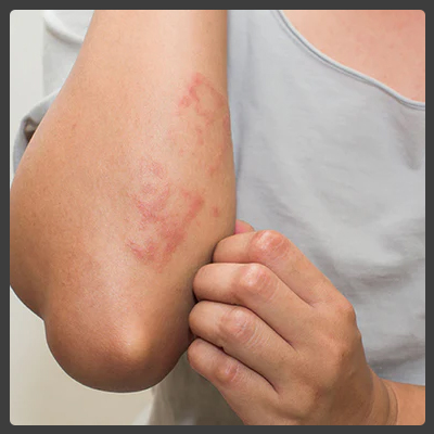 homeopathic treatment for Ringworm in homeopathy, Ringworm Treatment in  Patna & Ranchi