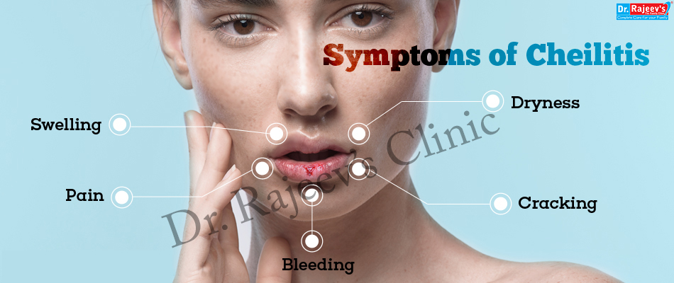 Homeopathy Treatment For Cheilitis