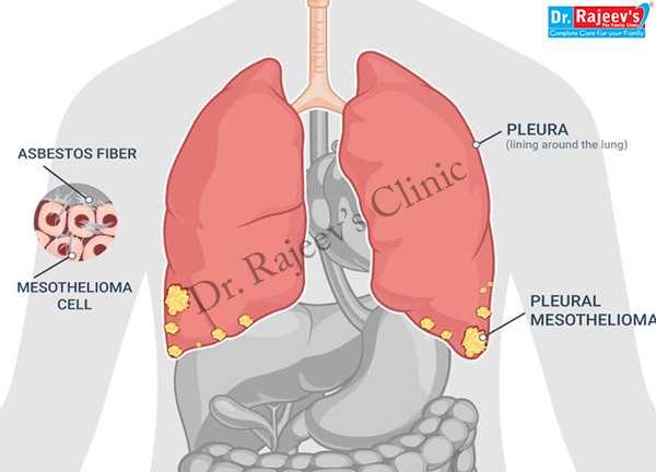 Signs Of Cancer In Lymph Nodes In Groin