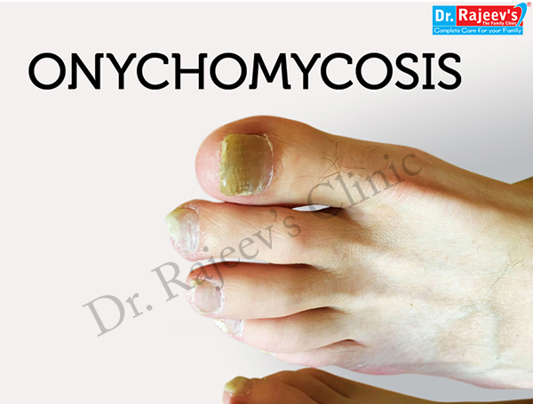 Toe Nail Fungus (Onychomycosis)