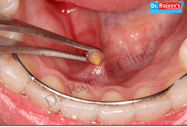 submandibular gland swelling home remedies