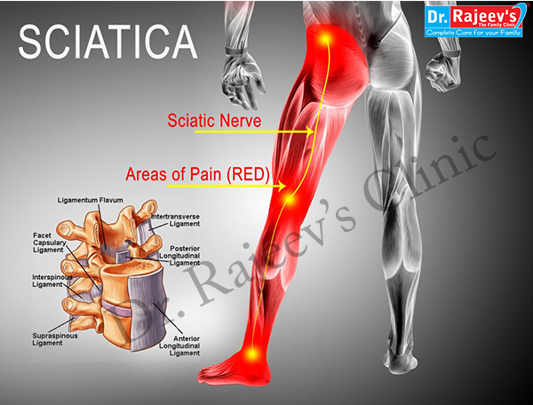 emg for sciatica